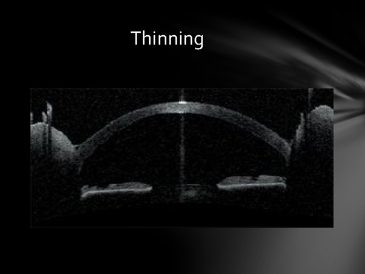 Thinning Thinning