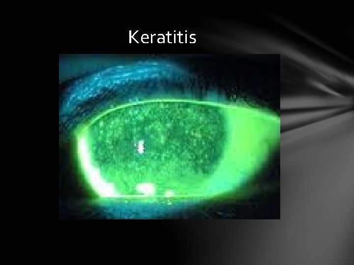 Keratitis Keratitis