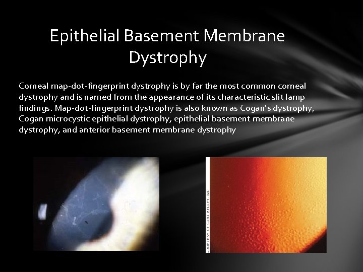 Epithelial Basement Membrane Dystrophy Corneal map-dot-fingerprint dystrophy is by far the most common corneal Epithelial Basement Membrane Dystrophy Corneal map-dot-fingerprint dystrophy is by far the most common corneal