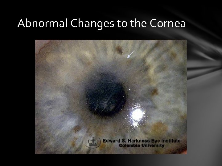 Abnormal Changes to the Cornea Abnormal Changes to the Cornea