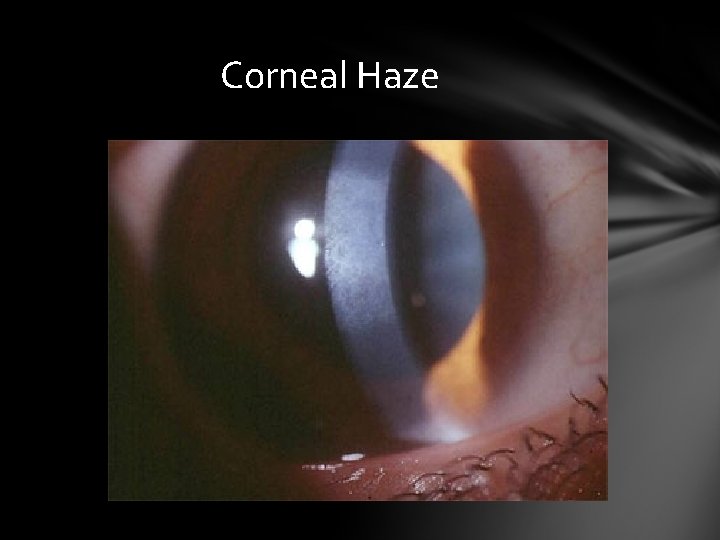 Corneal Haze Corneal Haze