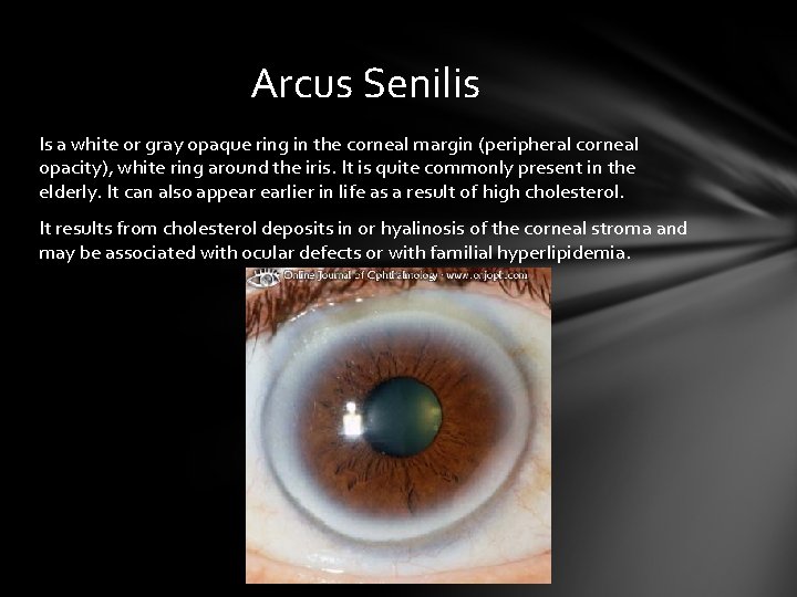 Arcus Senilis Is a white or gray opaque ring in the corneal margin (peripheral Arcus Senilis Is a white or gray opaque ring in the corneal margin (peripheral