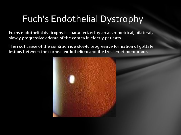 Fuch’s Endothelial Dystrophy Fuchs endothelial dystrophy is characterized by an asymmetrical, bilateral, slowly progressive Fuch’s Endothelial Dystrophy Fuchs endothelial dystrophy is characterized by an asymmetrical, bilateral, slowly progressive