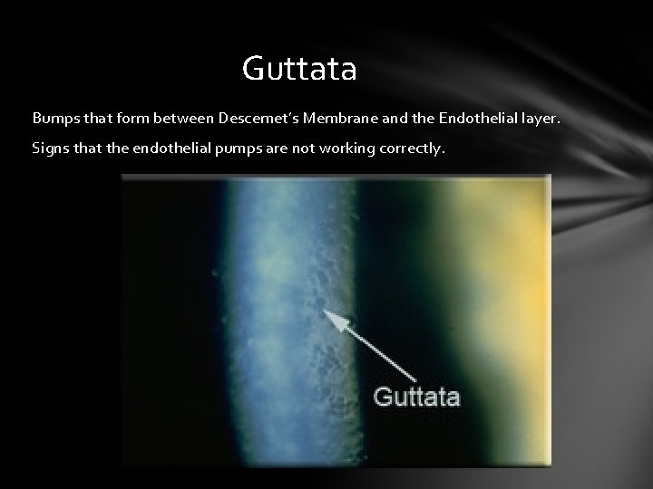 Guttata Bumps that form between Descemet’s Membrane and the Endothelial layer. Signs that the Guttata Bumps that form between Descemet’s Membrane and the Endothelial layer. Signs that the