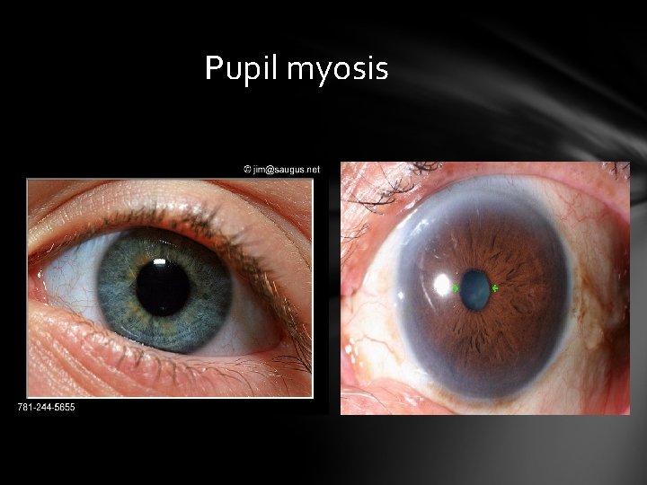 Pupil myosis Pupil myosis