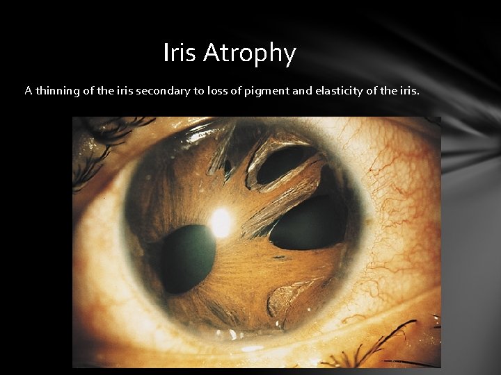 Iris Atrophy A thinning of the iris secondary to loss of pigment and elasticity Iris Atrophy A thinning of the iris secondary to loss of pigment and elasticity