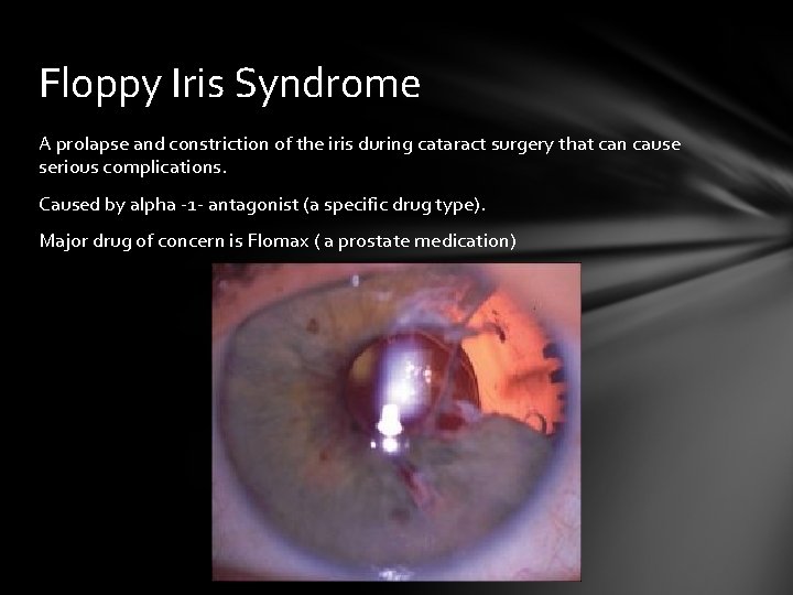 Floppy Iris Syndrome A prolapse and constriction of the iris during cataract surgery that Floppy Iris Syndrome A prolapse and constriction of the iris during cataract surgery that