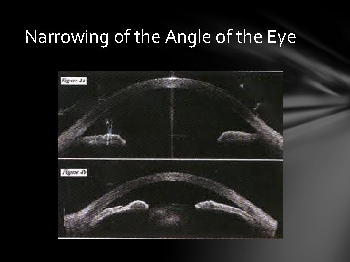 Narrowing of the Angle of the Eye Narrowing of the Angle of the Eye