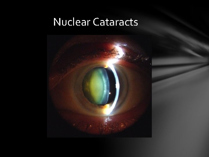 Nuclear Cataracts Nuclear Cataracts