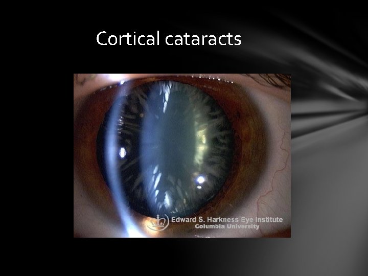 Cortical cataracts Cortical cataracts