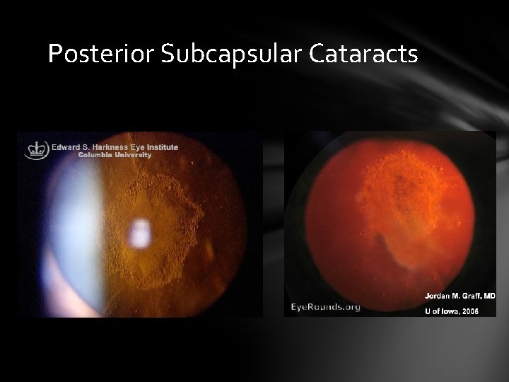 Posterior Subcapsular Cataracts Posterior Subcapsular Cataracts