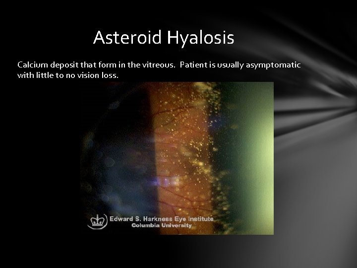 Asteroid Hyalosis Calcium deposit that form in the vitreous. Patient is usually asymptomatic with Asteroid Hyalosis Calcium deposit that form in the vitreous. Patient is usually asymptomatic with