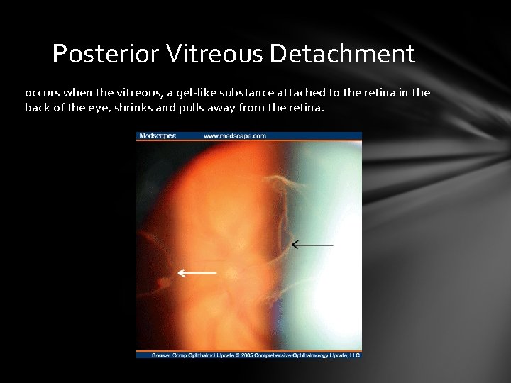 Posterior Vitreous Detachment occurs when the vitreous, a gel-like substance attached to the retina Posterior Vitreous Detachment occurs when the vitreous, a gel-like substance attached to the retina