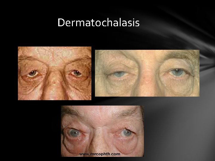 Dermatochalasis Dermatochalasis