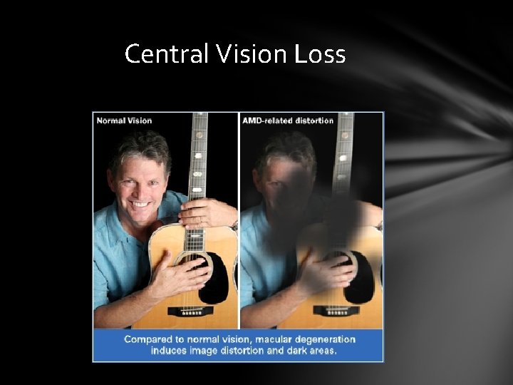 Central Vision Loss Central Vision Loss