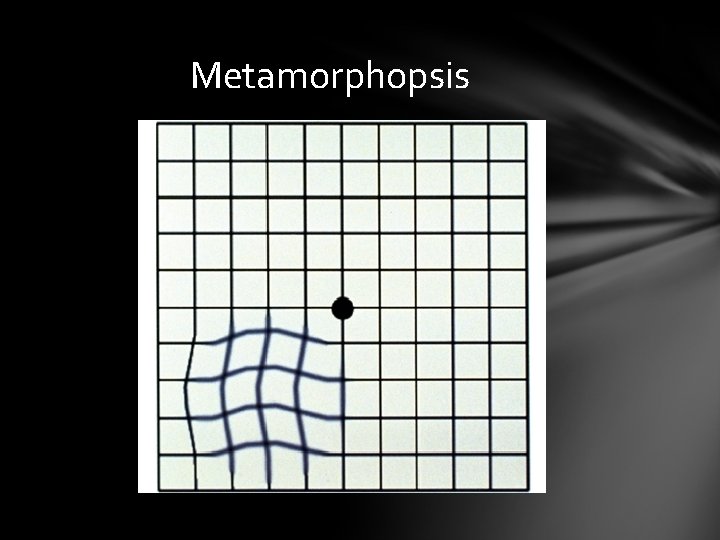 Metamorphopsis Metamorphopsis