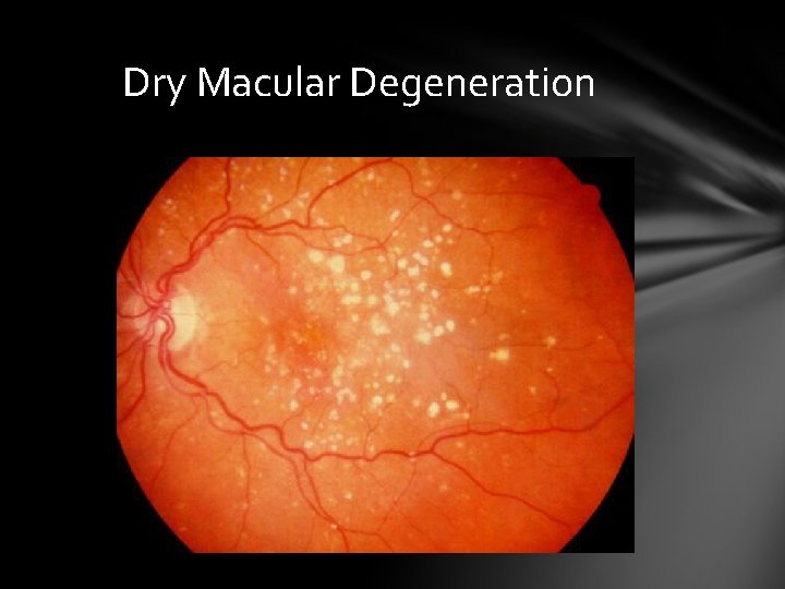 Dry Macular Degeneration Dry Macular Degeneration
