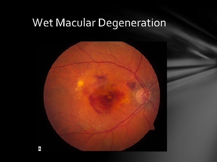 Wet Macular Degeneration Wet Macular Degeneration