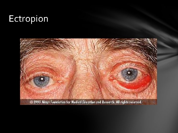 Ectropion Ectropion
