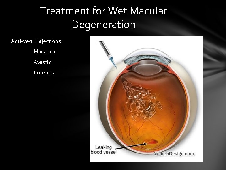 Treatment for Wet Macular Degeneration Anti-veg F injections Macagen Avastin Lucentis Treatment for Wet Macular Degeneration Anti-veg F injections Macagen Avastin Lucentis