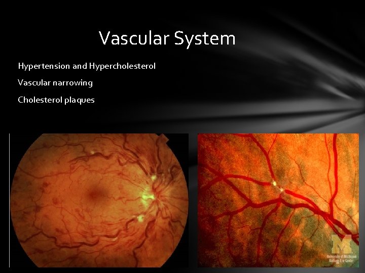 Vascular System Hypertension and Hypercholesterol Vascular narrowing Cholesterol plaques Vascular System Hypertension and Hypercholesterol Vascular narrowing Cholesterol plaques