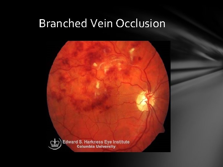 Branched Vein Occlusion Branched Vein Occlusion