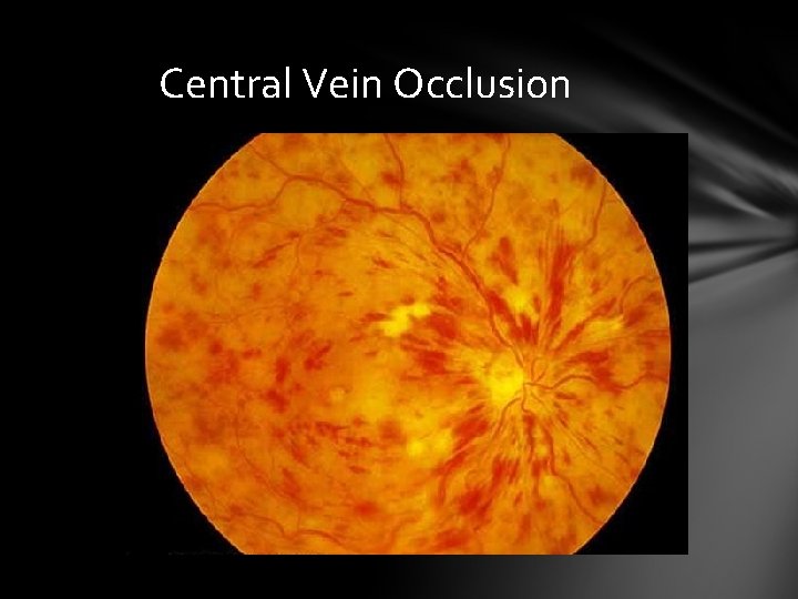 Central Vein Occlusion Central Vein Occlusion