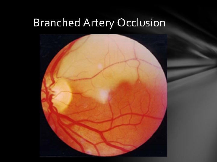 Branched Artery Occlusion Branched Artery Occlusion