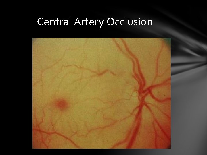 Central Artery Occlusion Central Artery Occlusion