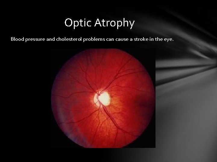 Optic Atrophy Blood pressure and cholesterol problems can cause a stroke in the eye. Optic Atrophy Blood pressure and cholesterol problems can cause a stroke in the eye.