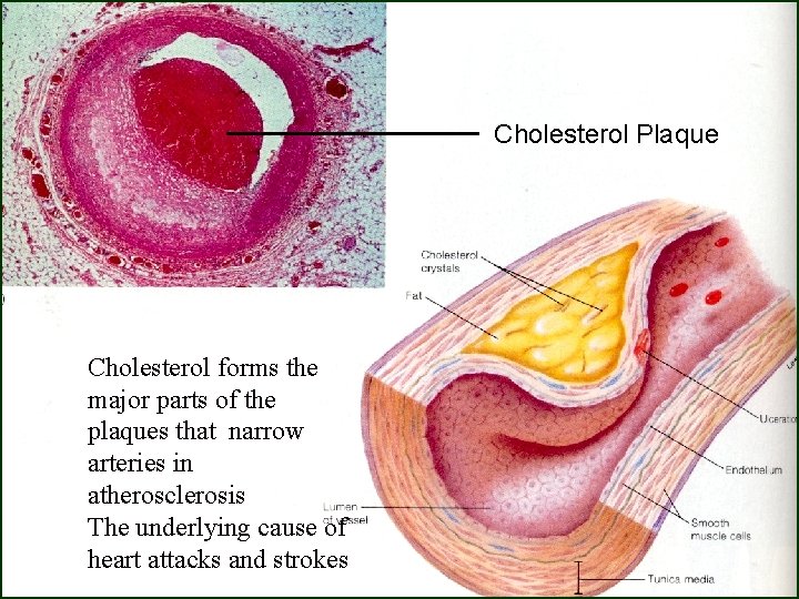 Cholesterol Plaque Cholesterol forms the major parts of the plaques that narrow arteries in