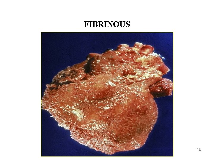 ACUTE INFLAMMATION FIBRINOUS 10 