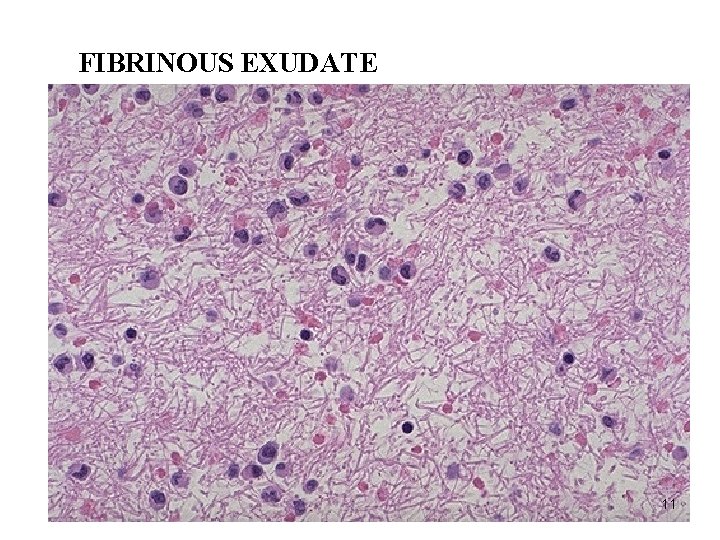 FIBRINOUS EXUDATE 11 