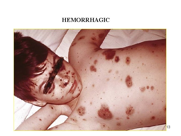 ACUTE INFLAMMATION HEMORRHAGIC 13 