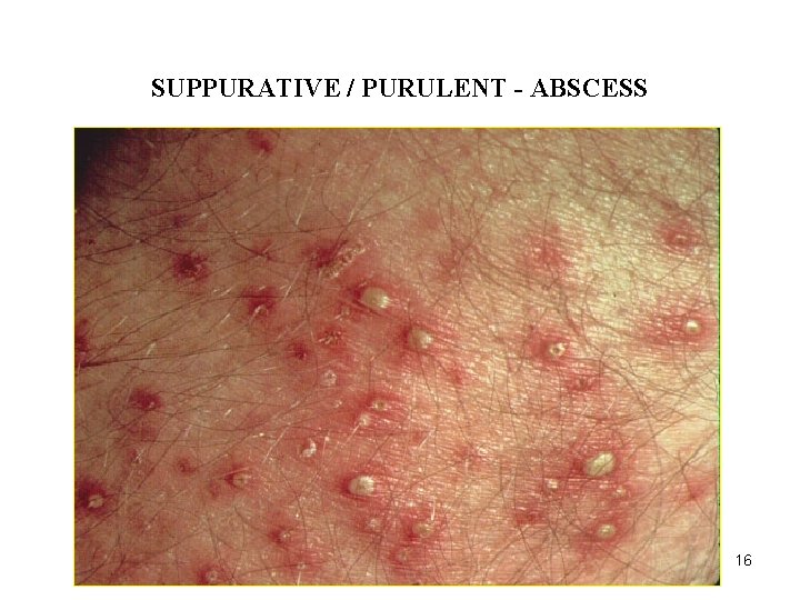 ACUTE INFLAMMATION SUPPURATIVE / PURULENT - ABSCESS 16 