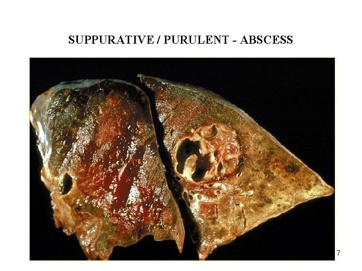 ACUTE INFLAMMATION SUPPURATIVE / PURULENT - ABSCESS 17 