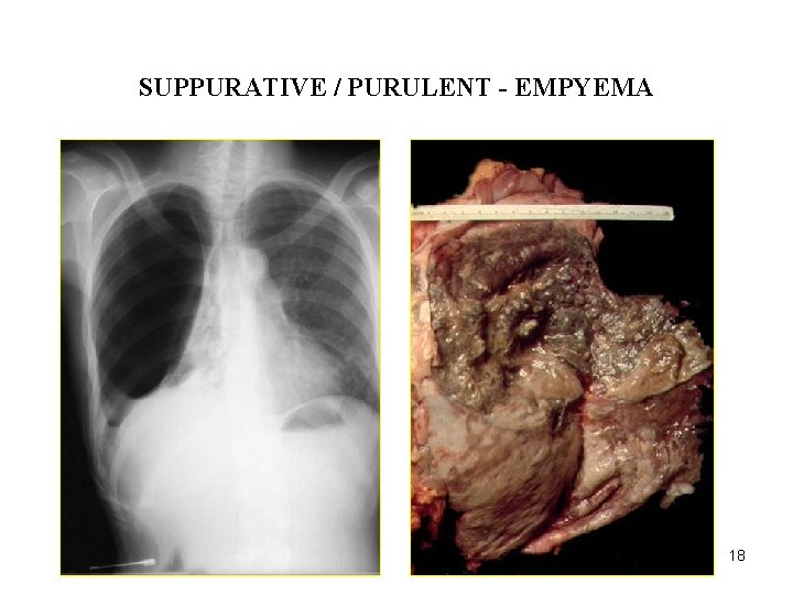 ACUTE INFLAMMATION SUPPURATIVE / PURULENT - EMPYEMA 18 