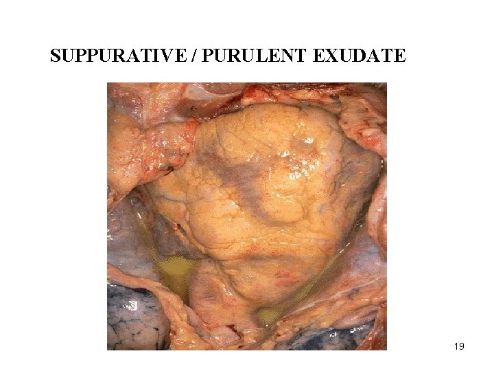 SUPPURATIVE / PURULENT EXUDATE 19 