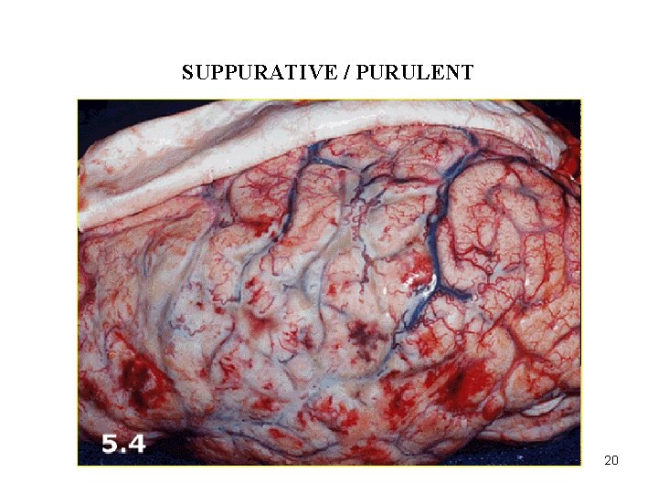 ACUTE INFLAMMATION SUPPURATIVE / PURULENT 20 