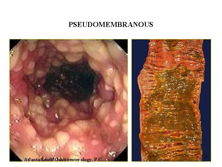 ACUTE INFLAMMATION PSEUDOMEMBRANOUS Atlanta South Gastroenterology, P. C. 22 