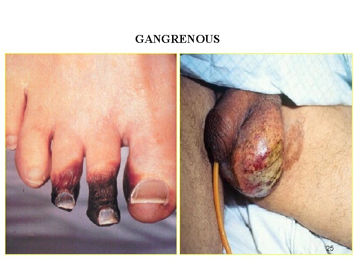 ACUTE INFLAMMATION GANGRENOUS 25 