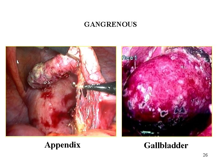 ACUTE INFLAMMATION GANGRENOUS Appendix Gallbladder 26 