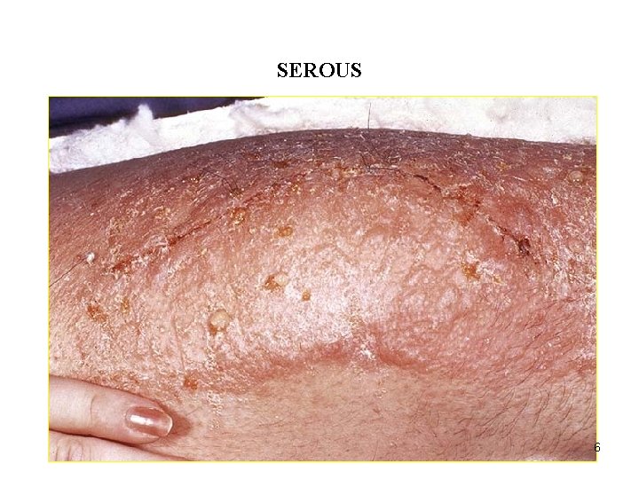 ACUTE INFLAMMATION SEROUS 6 