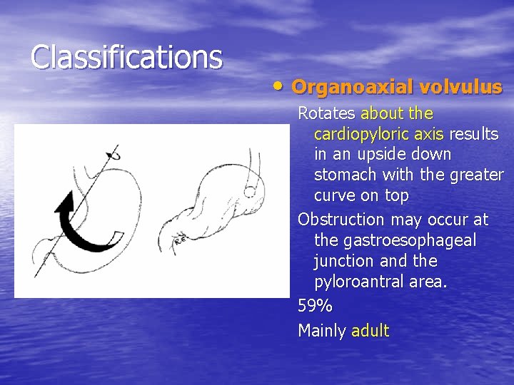 Classifications • Organoaxial volvulus Rotates about the cardiopyloric axis results in an upside down