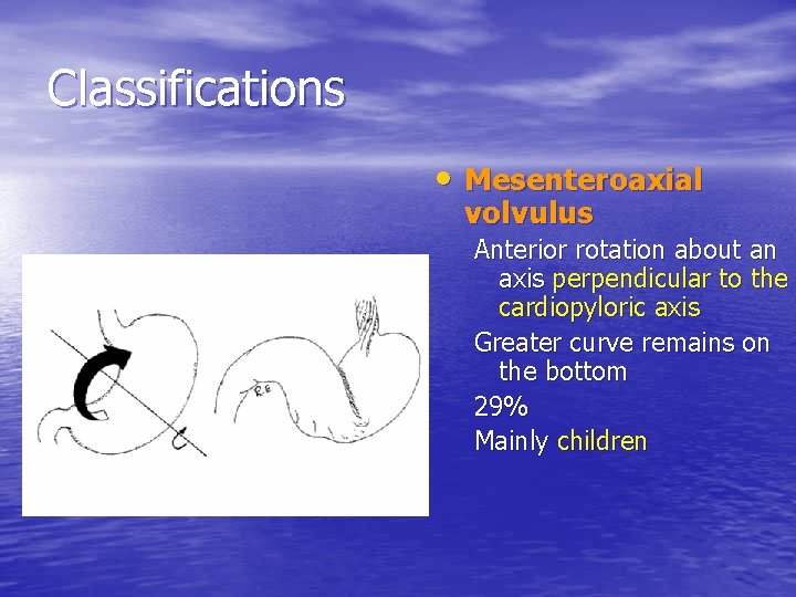 Classifications • Mesenteroaxial volvulus Anterior rotation about an axis perpendicular to the cardiopyloric axis