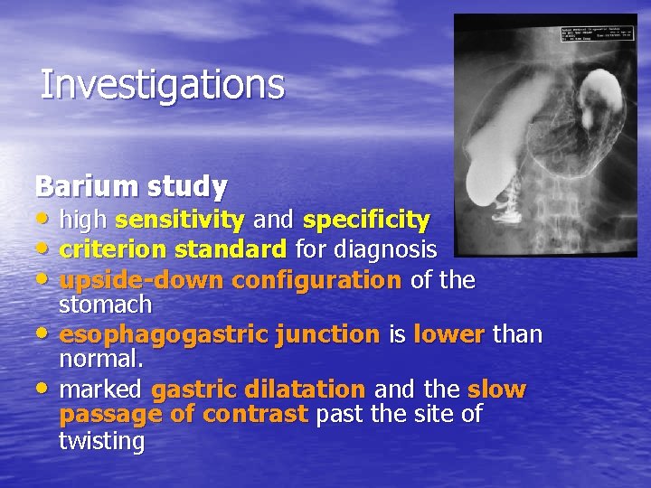 Investigations Barium study • high sensitivity and specificity • criterion standard for diagnosis •