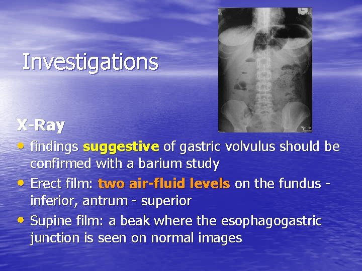 Investigations X-Ray • findings suggestive of gastric volvulus should be • • confirmed with