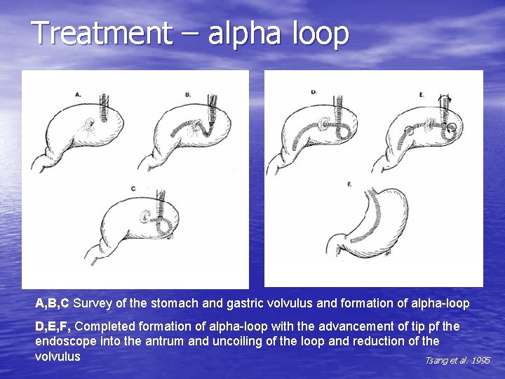 Treatment – alpha loop A, B, C Survey of the stomach and gastric volvulus