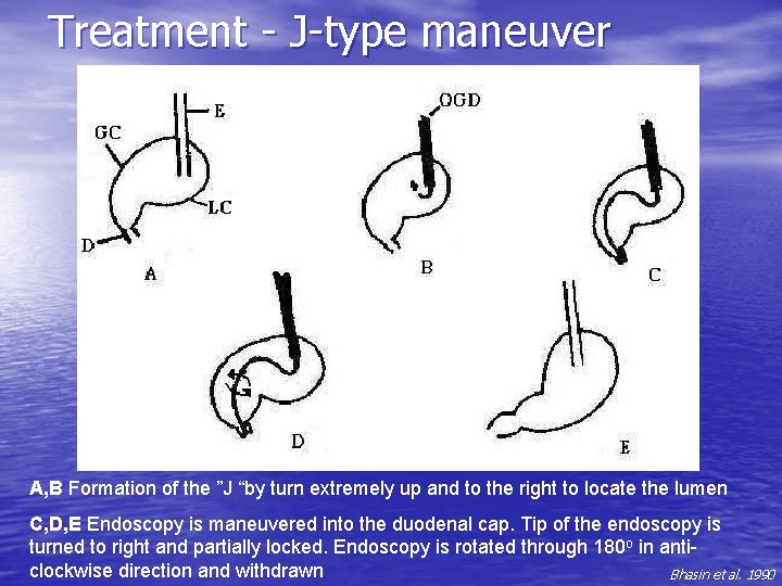 Treatment - J-type maneuver A, B Formation of the ”J “by turn extremely up