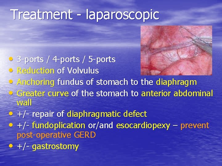 Treatment - laparoscopic • 3 -ports / 4 -ports / 5 -ports • Reduction